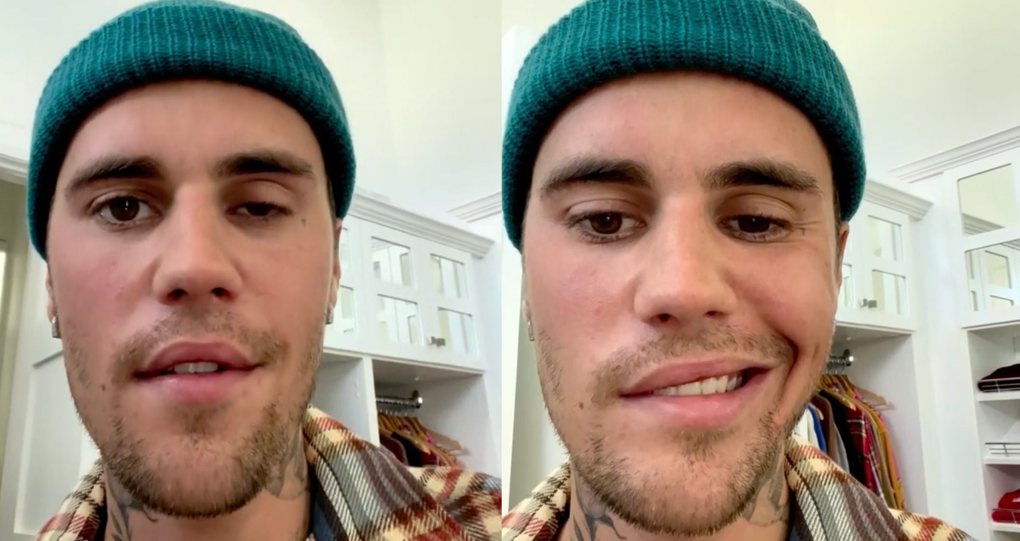 Justin Bieber sufre parálisis facial